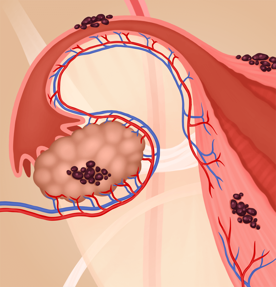 Close-up of the uterus, fallopian tube, and ovary with tissue endometrium tissue growing on these where it's not supposed to.